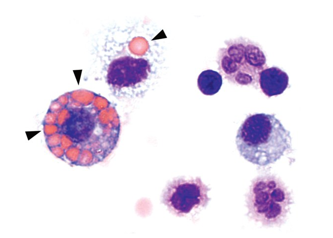 ANCA-associated vasculitis