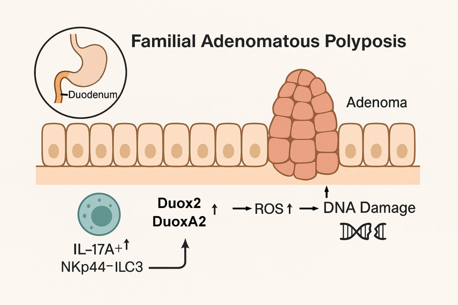 Process in the local immune system that can drive the development of cancer in hereditary FAP syndrome.